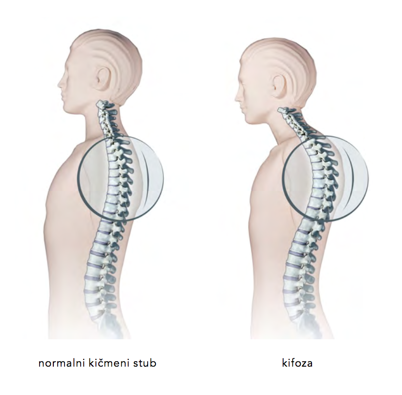 kifoza, balet za decu,zdraavo odrastanje,pravilan razvoj