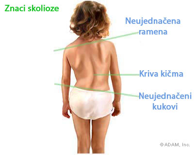skolioza, pravilan razvoj dece, korektivne vežbe, balet za decu